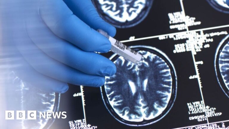 Read more about the article NHS will not fund new drug to slow Alzheimer’s