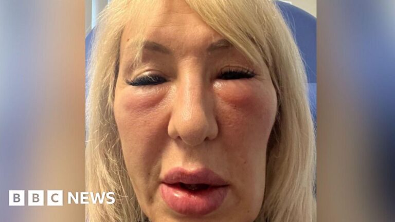 Read more about the article Botched fillers left Hull woman ‘looking like a gargoyle’