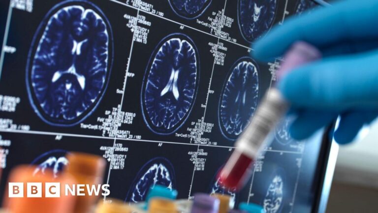 Read more about the article Breakthrough Alzheimer’s drugs too pricey to be offered on NHS