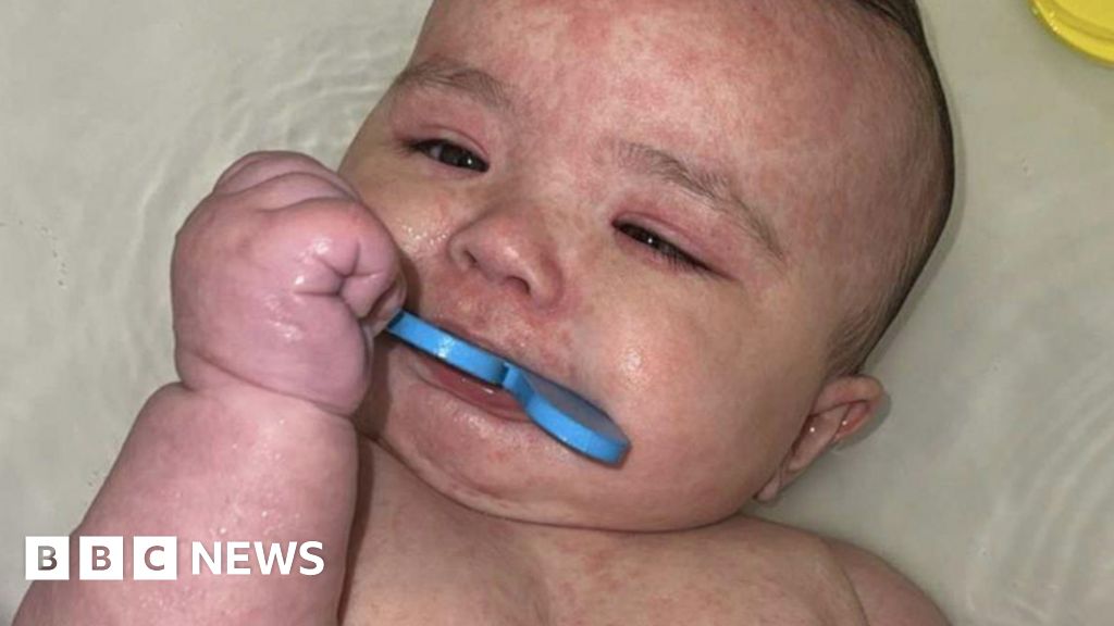 You are currently viewing How Canada became the centre of a measles outbreak in North America
