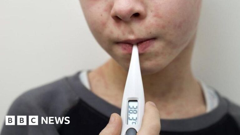 Read more about the article Why are measles cases rising in the UK and who can get the MMR vaccine?