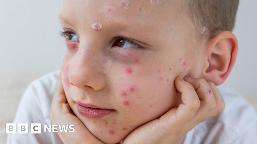 Read more about the article What is chickenpox and who can get the vaccine?